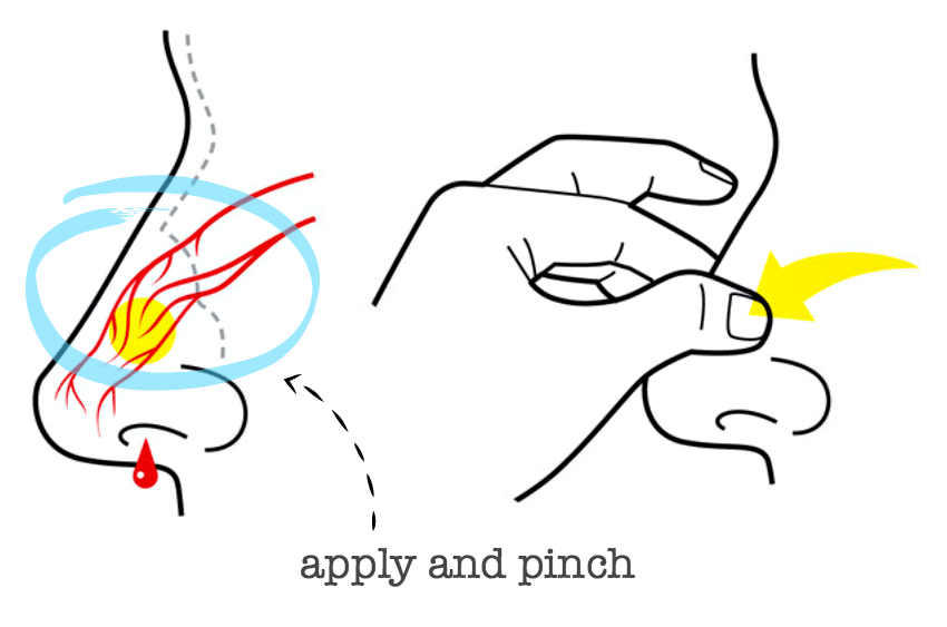 Stop and Prevent Common Nosebleeds - Camp Wander